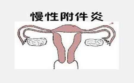 如何有效避免附件炎